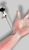 Wrist Arthroscopy